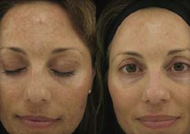 dermapeel before and after
